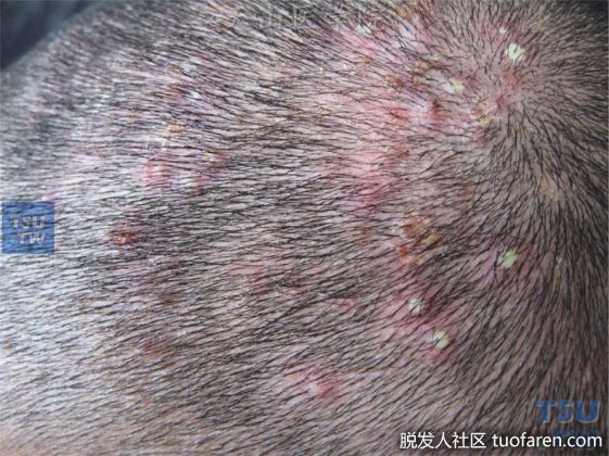 【圖】頭皮長“青春痘” 其實是毛囊炎