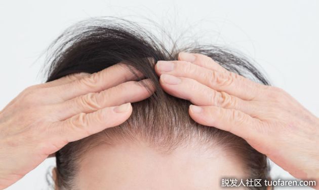 【圖】你是高額頭還是前額禿?小心髮際線後移這是禿頭信號!