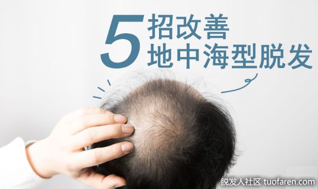 【圖】精選五招！改善地中海型脱髮