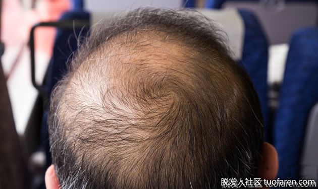 【圖】預防脱髮：改善掉髮的６種生活習慣！