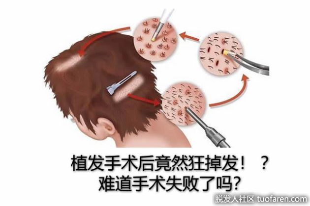 【圖】植髮手術後竟然狂掉髮！ ？難道手術失敗了嗎？