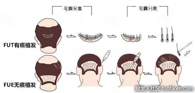【圖】使用自體毛髮移植真的不需要術後護理嗎？