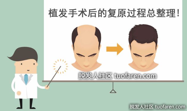 【圖】植髮手術後的復原過程總整理!