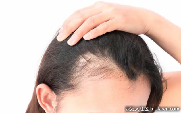 【圖】吸煙和脱髮有聯繫嗎？