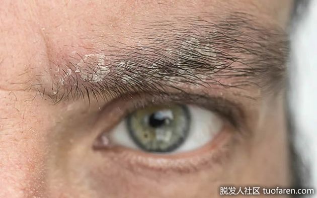 【圖】如何去除眉毛頭皮屑