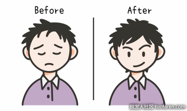 【圖】植髮手術也有失敗案例！ ？內有心得分享