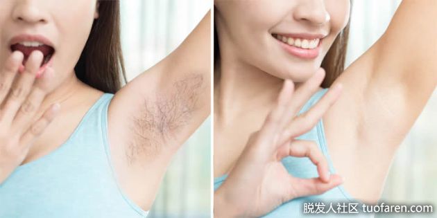 【圖】激光脱毛和電解脱毛：哪個對你的皮膚更好？