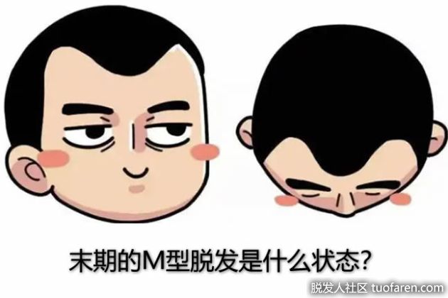 【圖】末期的Ｍ型脱髮是什麼狀態？ 【避免情況已無法挽救的方法】