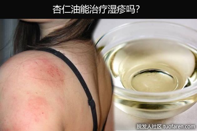 【圖】杏仁油能治療濕疹嗎？