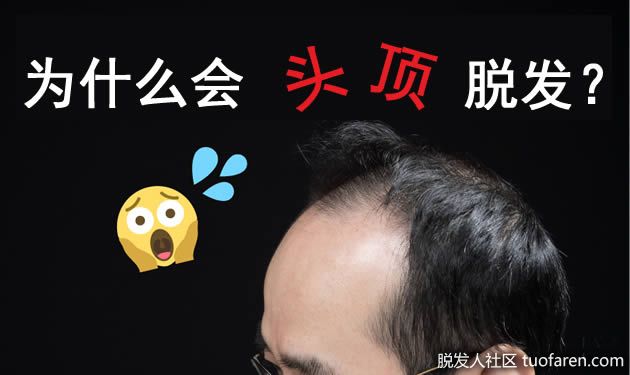 【圖】為什麼頭頂稀疏脱髮？脱髮原因出在雄激素! ?