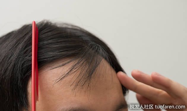 【圖】如何知道自己有沒有脱髮?用這幾種方法分辨M型脱髮!