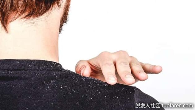 【圖】產生頭皮屑的原因 去除頭皮屑的方法(去除頭皮角質)