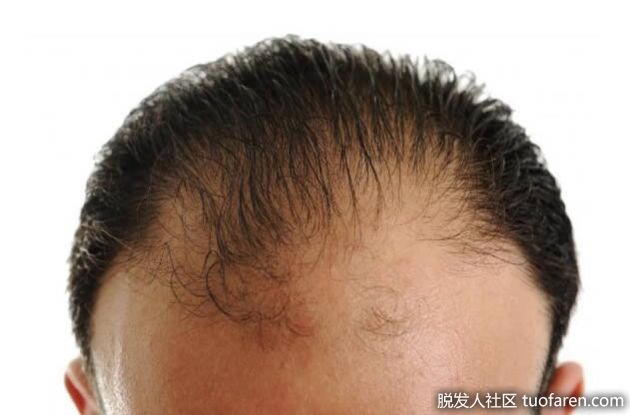 【圖】如何自然治療脱髮