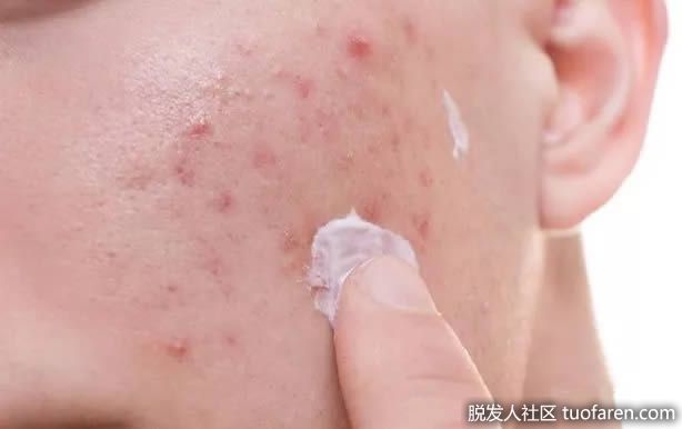 【圖】毛囊炎的5種自制療法