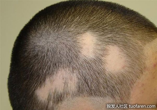 【圖】青少年壓力性圓形脱髮