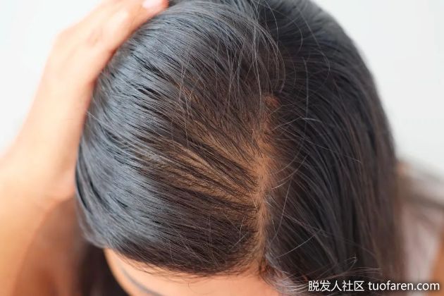 【圖】為什麼隨着冬天的臨近，頭髮越掉越多？