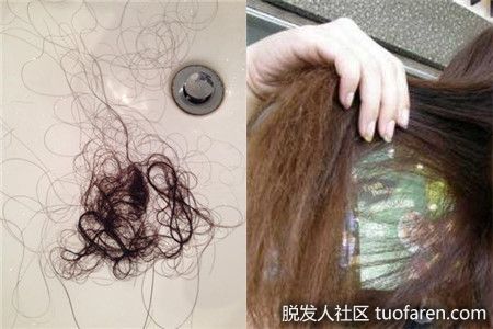 【圖】2個症狀可以確認是否存在脱髮