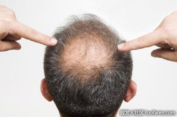 【圖】治療脱髮前要檢查的 3 個習慣