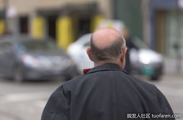 【圖】頭頂脱髮的早期症狀及有效的治療和預防方法