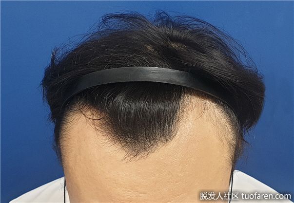 【圖】脱髮自我診斷方法