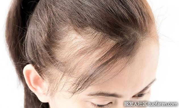 【圖】女性脱髮更難治療... 推薦5個預防習慣