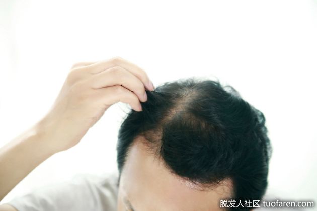 【圖】脱髮藥，用得越多越有效？ '錯'