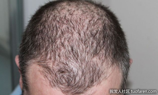 【圖】M型脱髮的10個早期症狀及有效預防方法