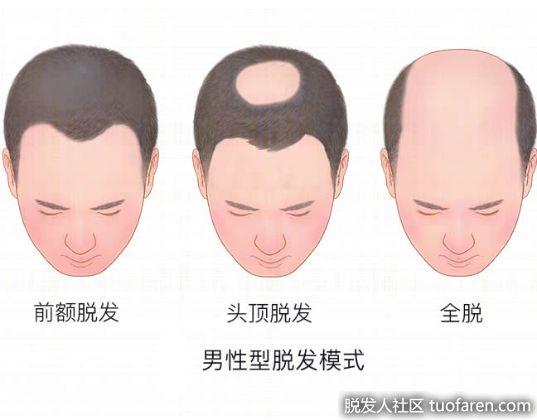【圖】男性型脱髮概述