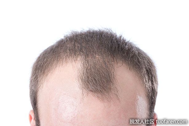 【圖】脱髮和植髮後，應結合持續藥物治療