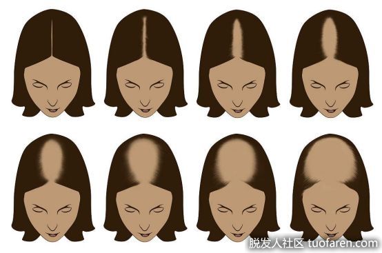 【圖】少女脱髮嚴重是什麼原因 女孩子頭髮禿了怎麼辦