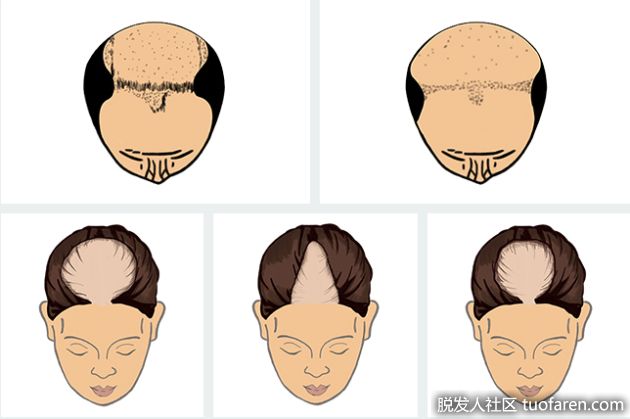 【圖】男性型脱髮的原因、症狀、治療、預防方法