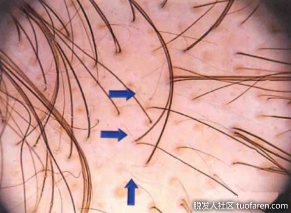 【圖】如何自我診斷脱髮？ “這部分”的厚度很重要
