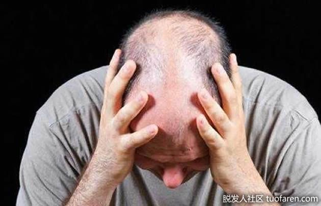 【圖】怎麼準確判斷自己是否脱髮了？