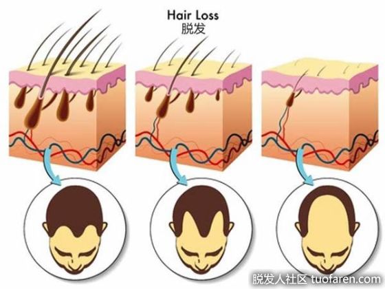 【圖】男性脱髮最有效的治療方法是什麼？