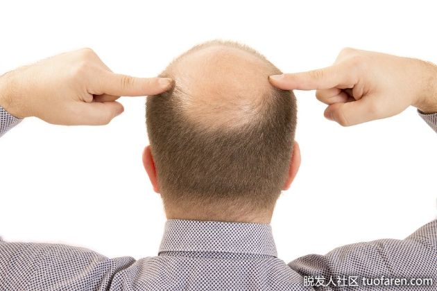 【圖】為什麼禿頂的人的“後面”不掉？