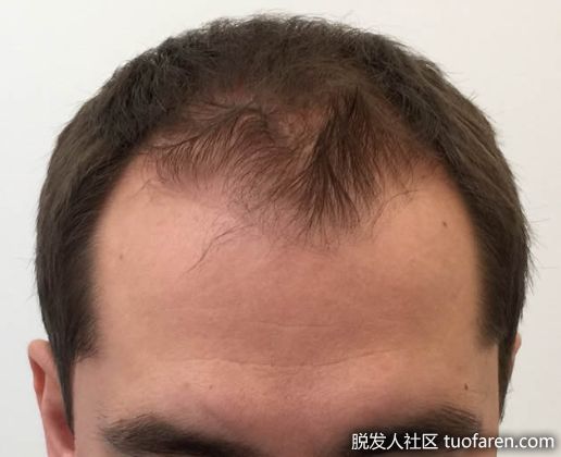 【圖】男性型脱髮的早期症狀及治療