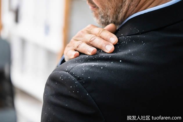 【圖】去除頭皮屑的 10 種流行方法