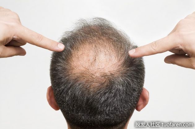 【圖】雄激素性脱髮的症狀和預防