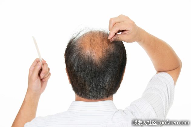 【圖】雄激素性脱髮的原因和治療方法