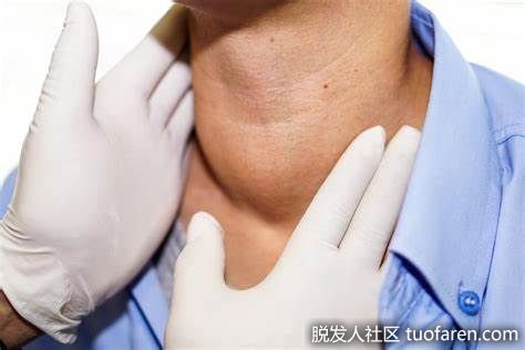 【圖】體內碘過量的症狀、原因和治療