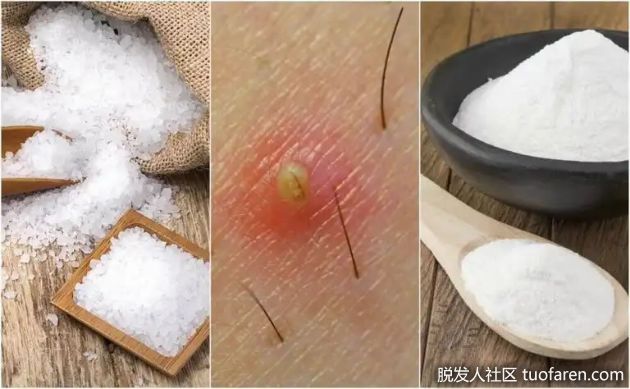 【圖】毛髮內生的5種天然解方