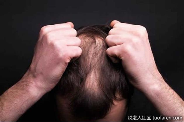 【圖】為什麼頭髮會脱落？脱髮的8個原因