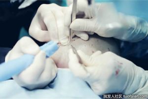 疤痕植髮會失敗嗎？