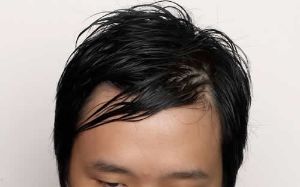 油性頭皮會導致脱髮嗎?