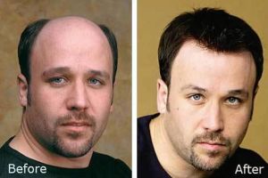 什麼是非手術植髮?