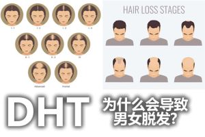 DHT是什麼?為什麼會導致男女脱髮?