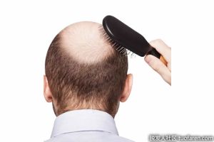 雙氫睾酮(DHT)脱髮是什麼?如何治療?