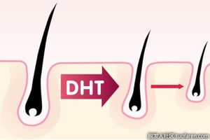 DHT（二氫睾酮）是什麼，它是如何影響頭髮生長的？