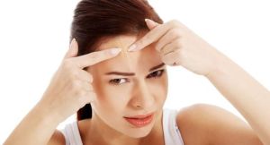 頭皮屑和痤瘡有什麼關係?