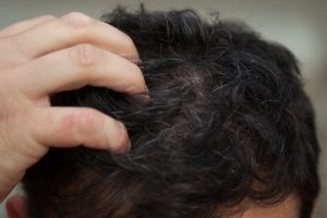 【組圖】如何清潔頭皮